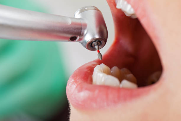 Best Chipped Tooth Repair Near Me  in Stow, OH
